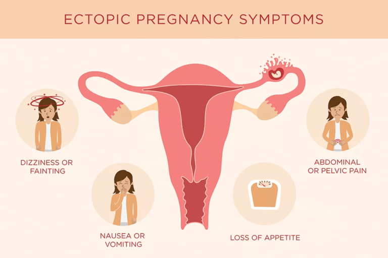 Ectopic Pregnancy Causes Symptoms Treatment Public Health Notes