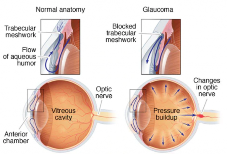 understanding-acute-angle-closure-glaucoma-vtomb