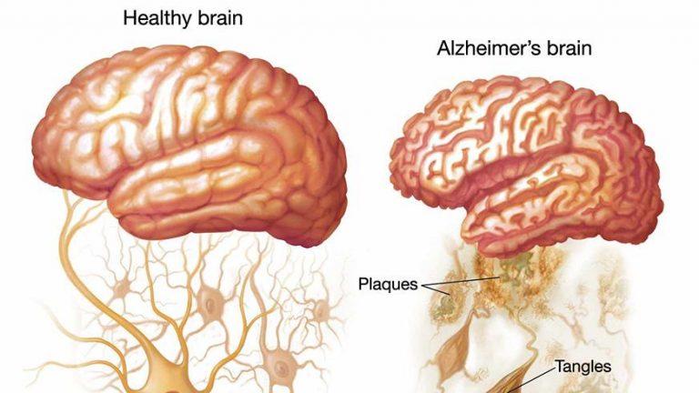 Dementia And Alzheimers Disease Public Health Notes