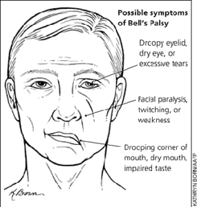 Facial palsy