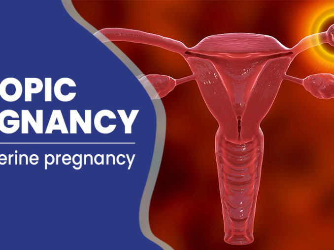 Causes Of Ectopic Pregnancy Archives Public Health Notes