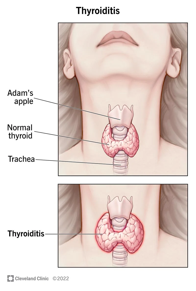 Thyroid Causes Symptoms And Treatment Public Health Notes