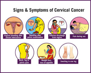 Cervical cancer: Causes, Symptoms & Treatment - Public Health Notes