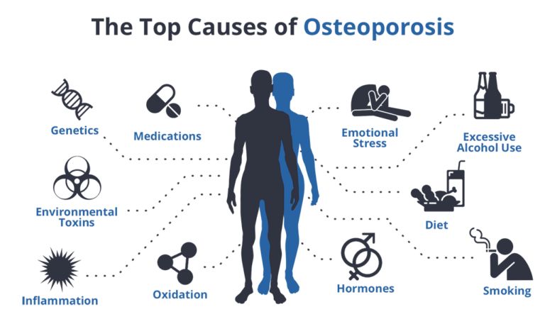 Osteoporosis Causes Symptoms And Treatment Public Health Notes 0953