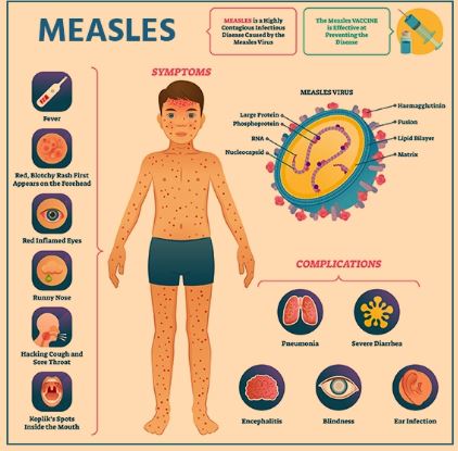 Measles: Symptoms, Prevention & Treatment - Public Health Notes