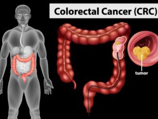 Colorectal cancer