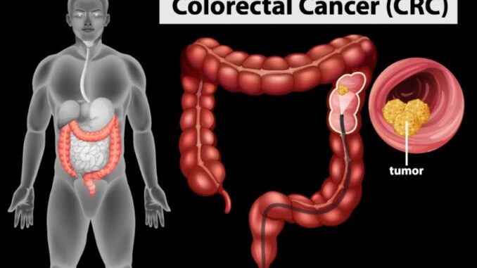 Colorectal cancer