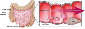 Colorectal cancer