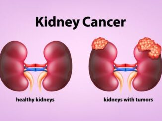 Kidney cancer