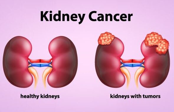 Kidney cancer