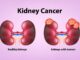 Kidney cancer