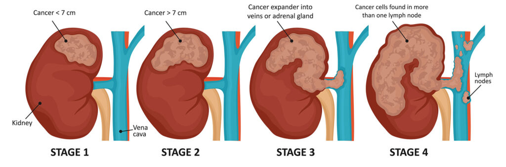 Kidney Cancer: Types, Symptoms and Treatment - Public Health Notes