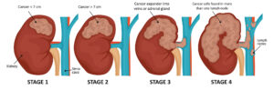 kidney cancer