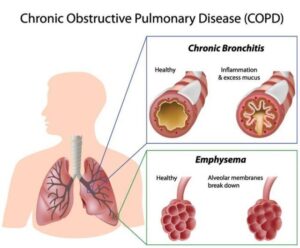 Types of COPD