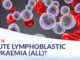 Acute Lymphoblastic Leukemia (ALL)