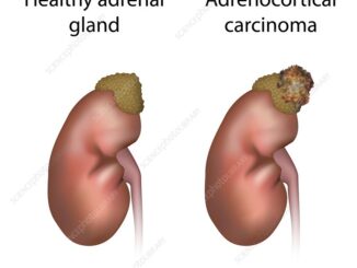 adrenocortical carcinoma