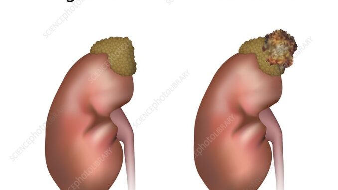 adrenocortical carcinoma