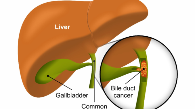 Bile duct cancer