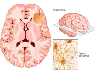 Astrocytoma/brain cancer