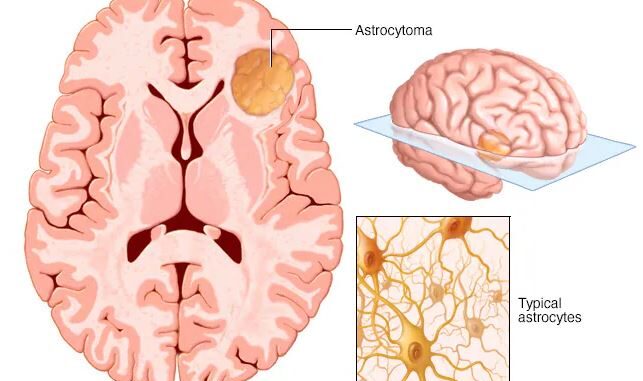 Astrocytoma/brain cancer
