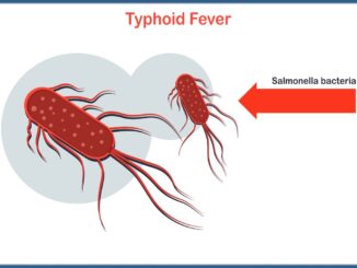 Typhoid fever